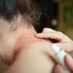 En person applicerar kräm på en röd, fläckig hud på nacken, troligen en allergisk reaktion.