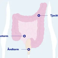 Illustration av tunntarm, tjocktarm och ändtarm. Kan visa var ett stopp i magen kan uppstå.