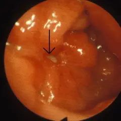 Endoskopisk bild av magsäcken visar rodnad och svullnad, tecken på inflammation magsäcken. En pil pekar mot en liten vit fläck.