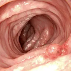 Insidan av tarmen visar veck och en utväxt, en polyp.