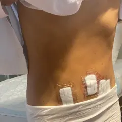 Efter operation för cysta i magen, syns plåster på ryggen.