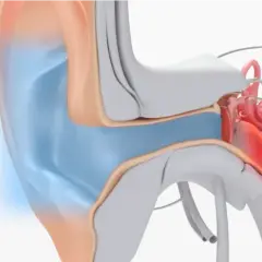 Illustration av örats anatomi, visar hur man kan ta bort vaxpropp för att återställa hörseln.