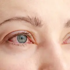 Röda, irriterade ögon med synliga blodkärl, ett tydligt tecken på kattallergi symptom.