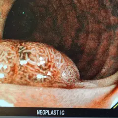 Bild visar en tarm med en stor, oregelbunden polyp. Detta kan vara en del av svaret på varför man får polyper i tarmen.