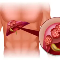 Illustration av lever med tumörer. Förstorad bild visar detaljer av tumörerna, som kan vara tecken på inflammation i levern symtom.