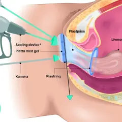 Illustration av en minimalinvasiv endometrios operation med kamera och instrument som arbetar mot livmodern.