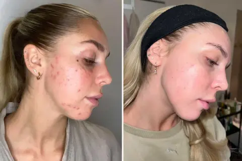 Före- och efterbilder visar en ung kvinna med akne som förbättrats avsevärt. Kanske en del av hennes resa att sluta med p-piller och hitta en hudvårdsrutin som fungerar.