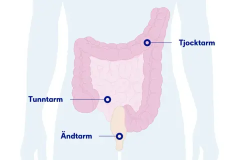 Illustration av tunntarm, tjocktarm och ändtarm. Kan visa var ett stopp i magen kan uppstå.