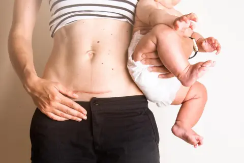 En kvinna håller sitt barn. Hon har ett ärr på magen efter ett kejsarsnitt, ett tecken på att hon valt kejsarsnitt eller fått ett avslag på vaginal förlossning.