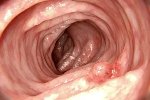 Insidan av tarmen visar veck och en utväxt, en polyp.
