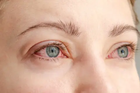 Röda, irriterade ögon med synliga blodkärl, ett tydligt tecken på kattallergi symptom.