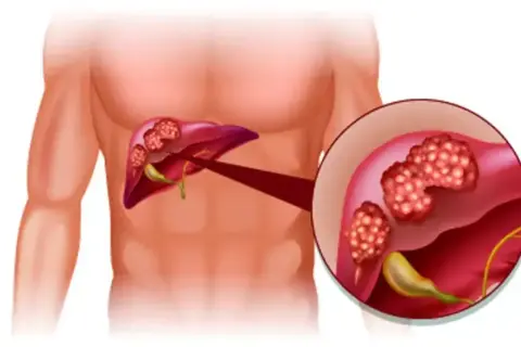 Illustration av lever med tumörer. Förstorad bild visar detaljer av tumörerna, som kan vara tecken på inflammation i levern symtom.