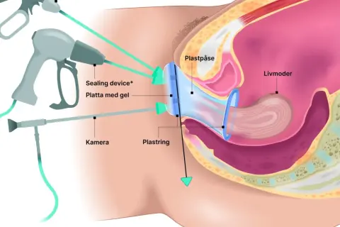 Illustration av en minimalinvasiv endometrios operation med kamera och instrument som arbetar mot livmodern.