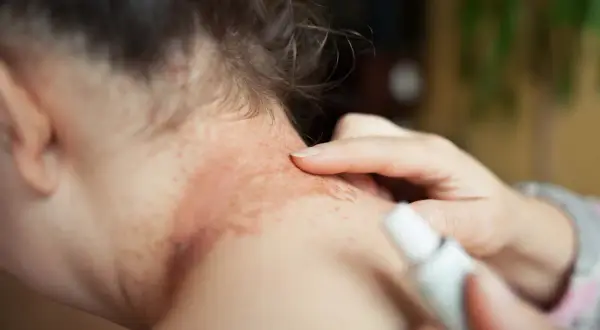 En person applicerar kräm på en röd, fläckig hud på nacken, troligen en allergisk reaktion.