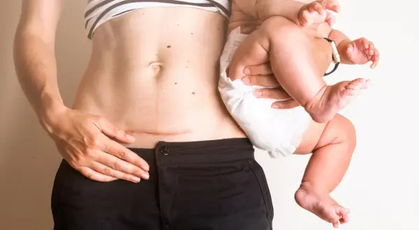 En kvinna håller sitt barn. Hon har ett ärr på magen efter ett kejsarsnitt, ett tecken på att hon valt kejsarsnitt eller fått ett avslag på vaginal förlossning.