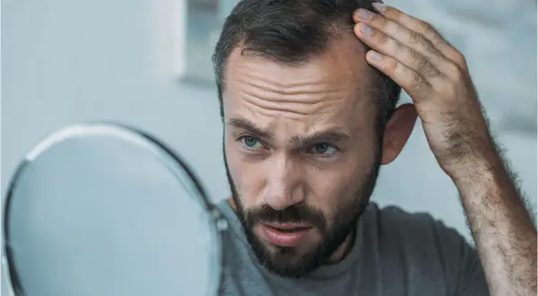 Man med skägg och bekymrat uttryck undersöker sitt tunnare hår i spegeln, möjligtvis relaterat till hypotyreos håravfall.