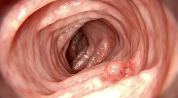 Insidan av tarmen visar veck och en utväxt, en polyp.