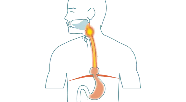 Illustration av matsmältningssystemet med fokus på halsen och magsäcken. Kan visa tolvfingertarmen inflammation symtom.