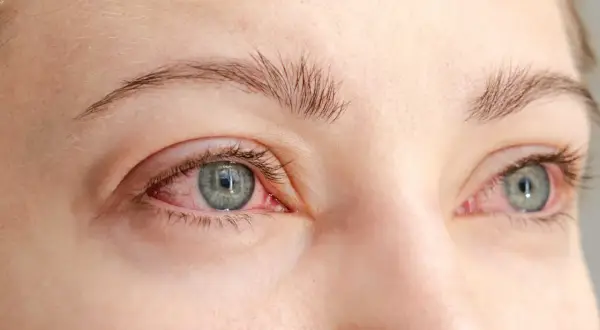 Röda, irriterade ögon med synliga blodkärl, ett tydligt tecken på kattallergi symptom.