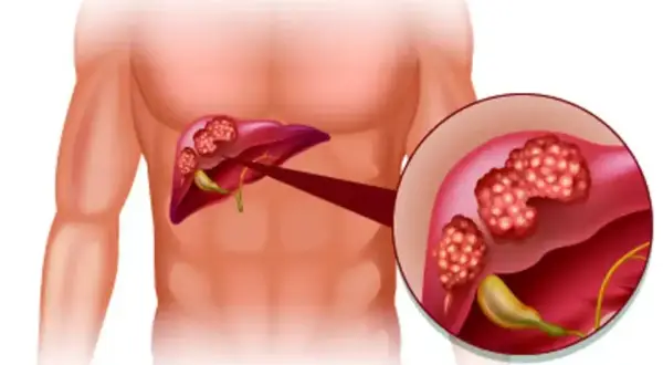 Illustration av lever med tumörer. Förstorad bild visar detaljer av tumörerna, som kan vara tecken på inflammation i levern symtom.