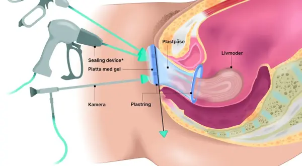 Illustration av en minimalinvasiv endometrios operation med kamera och instrument som arbetar mot livmodern.