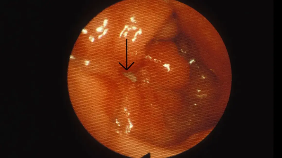 Endoskopisk bild av magsäcken visar rodnad och svullnad, tecken på inflammation magsäcken. En pil pekar mot en liten vit fläck.