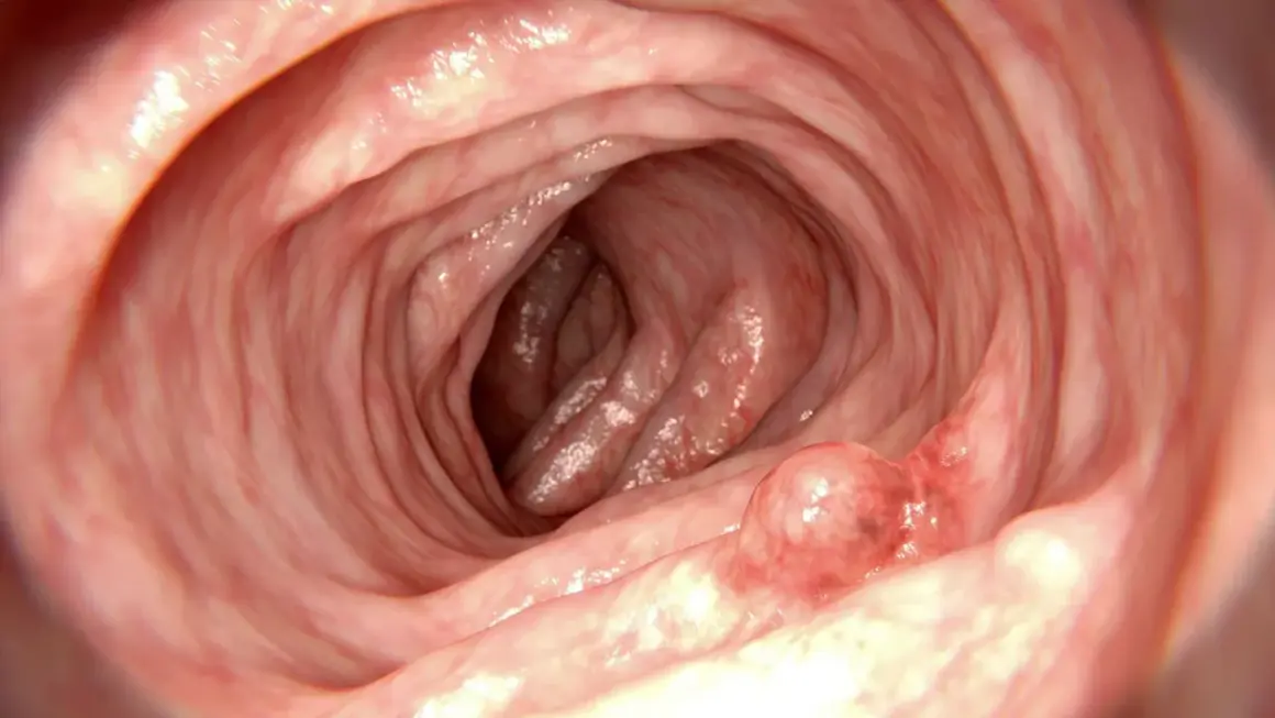 Insidan av tarmen visar veck och en utväxt, en polyp.