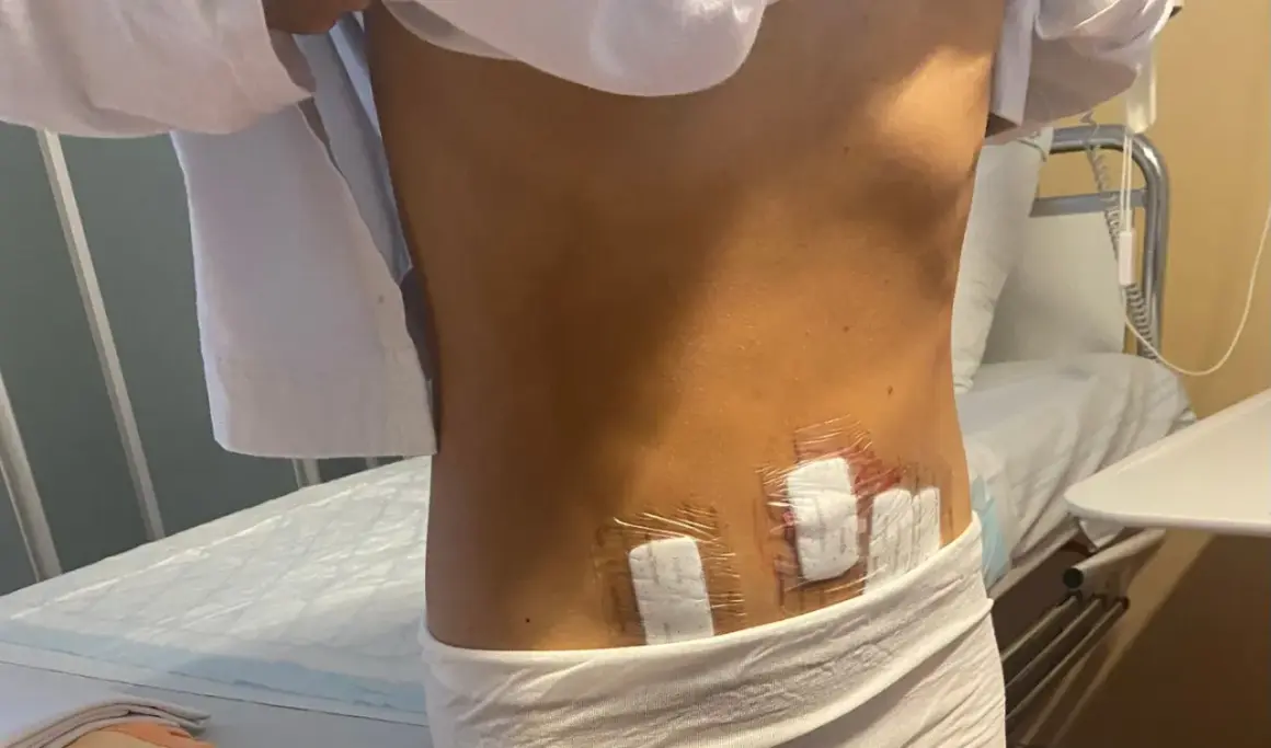 Efter operation för cysta i magen, syns plåster på ryggen.