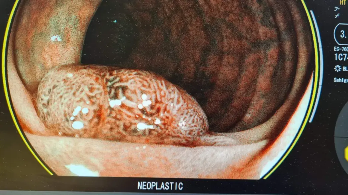 Bild visar en tarm med en stor, oregelbunden polyp. Detta kan vara en del av svaret på varför man får polyper i tarmen.