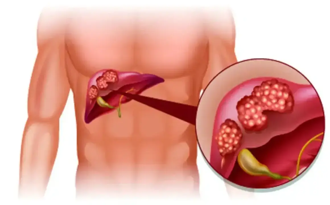 Illustration av lever med tumörer. Förstorad bild visar detaljer av tumörerna, som kan vara tecken på inflammation i levern symtom.