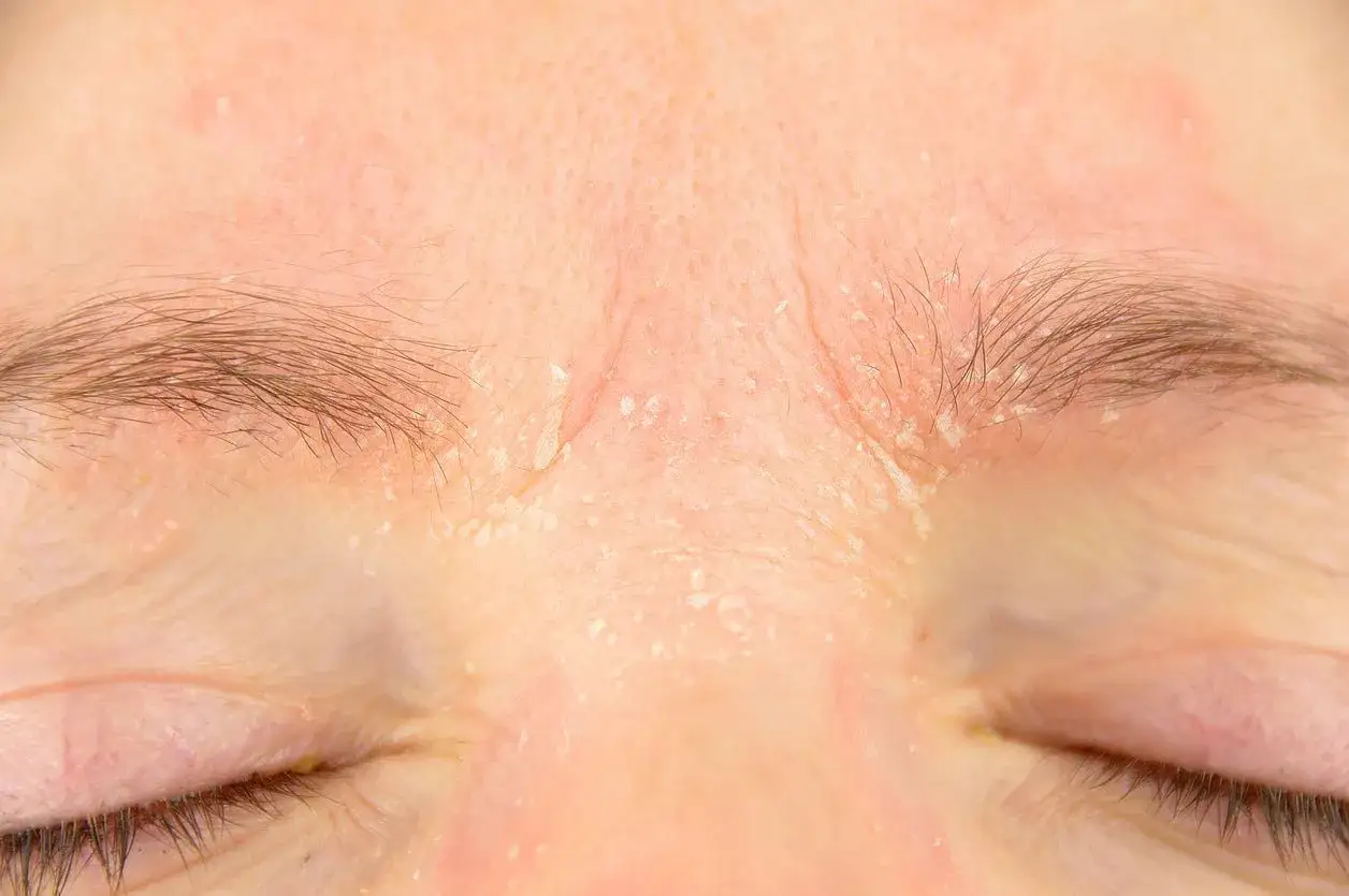 Hud som flagnar och är röd runt ögonbrynen, troligen retinol biverkningar.