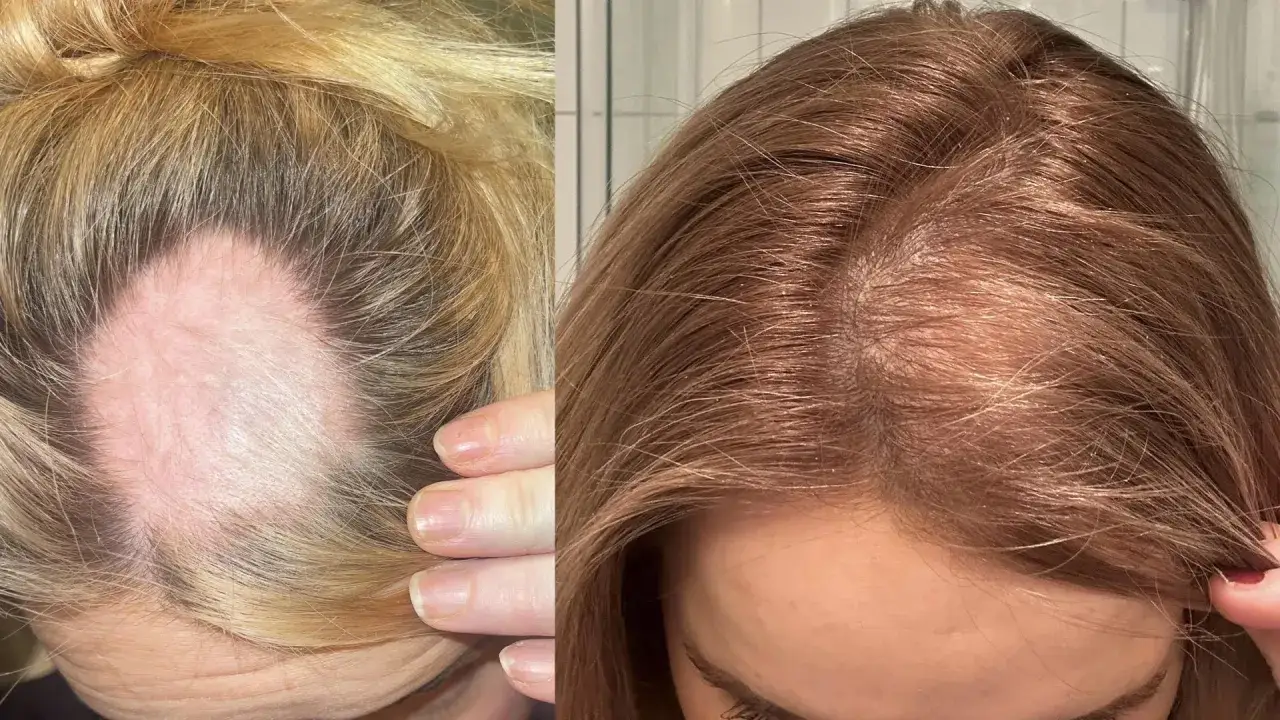 Före och efter-bilder visar förbättrat hårfäste efter behandling för hypotyreos håravfall.