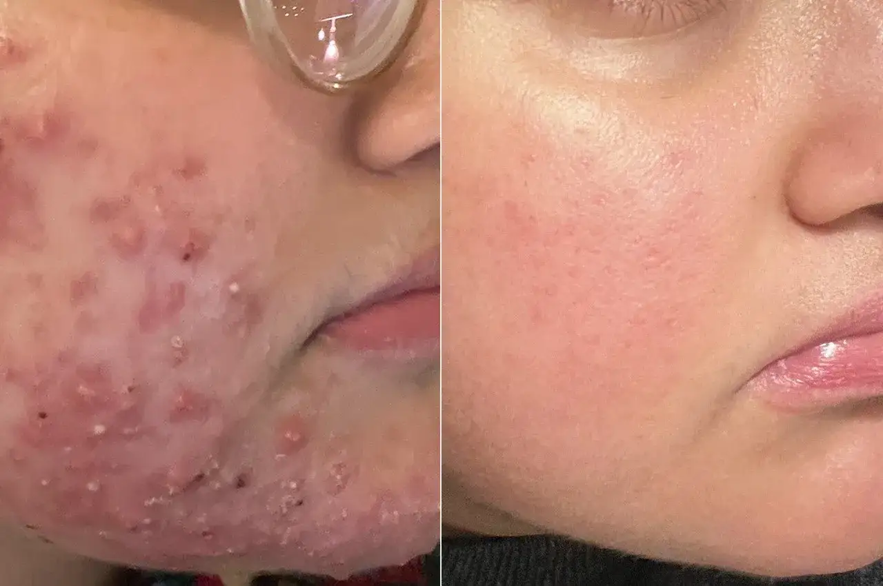 Före- och efterbilder visar tydlig förbättring av akne efter behandling med tretinoin recept.