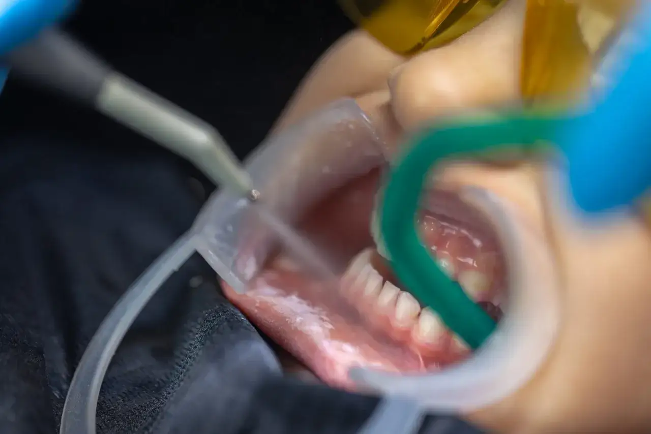 Tandläkare utför gingivit behandling med instrument och munhålsretraktor.