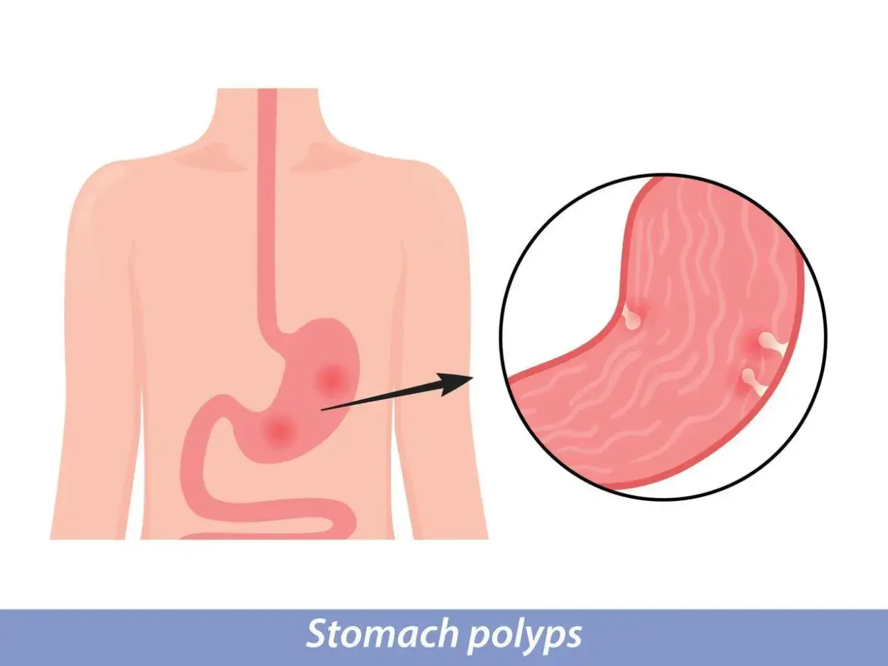 Illustration av magsäcken med synliga polyper. En närbild visar flera små utväxter på magsäckens insida.