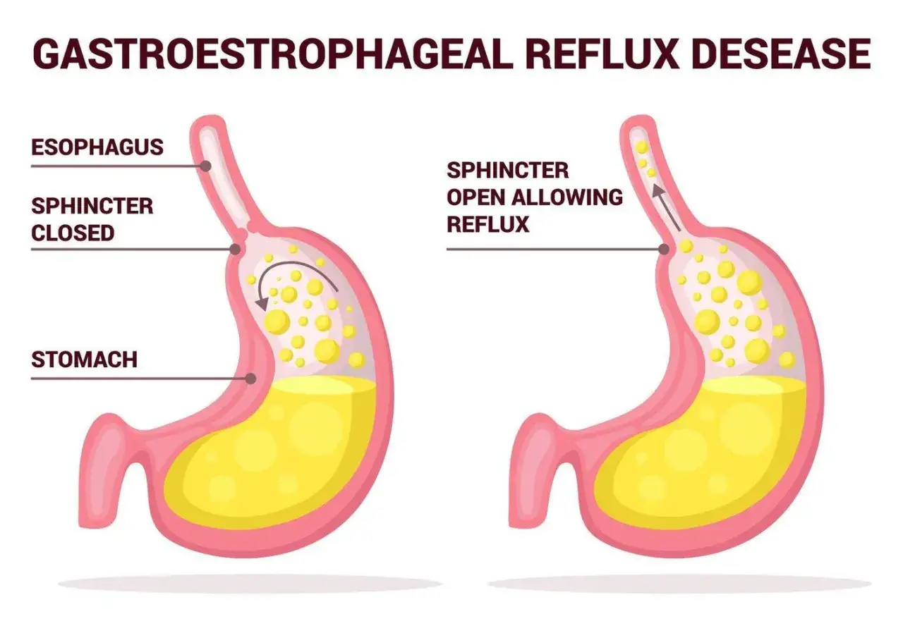 Illustration visar magmunnen som &auml;r &ouml;ppen och till&aring;ter reflux, vilket kan orsaka ont i magen.