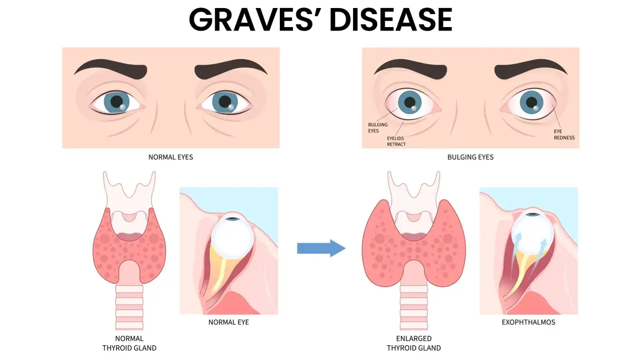 Illustration visar hur graves sjukdom påverkar ögonen med utstående ögon och en förstorad sköldkörtel, samt exoftalmos.
