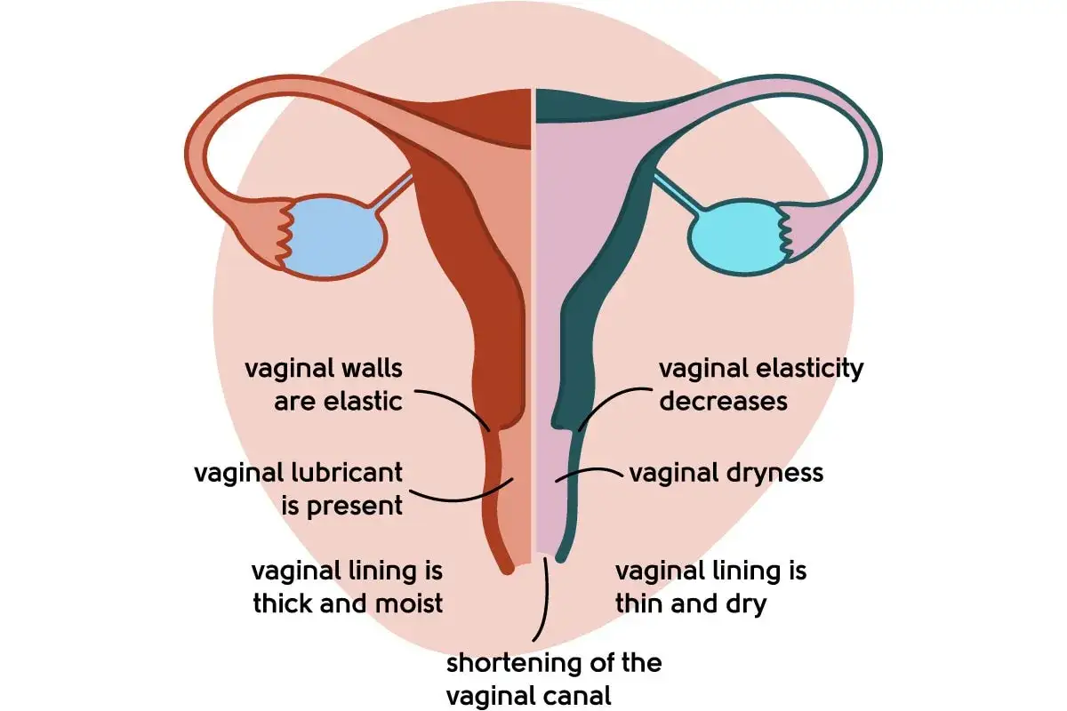 Illustration visar hur klimakteriet påverkar underlivet: minskad elasticitet, torrhet och att urin luktar illa.