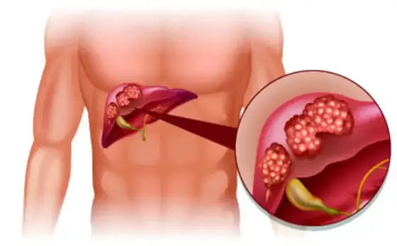 Leverinflammation - Känn igen symtomen i tid