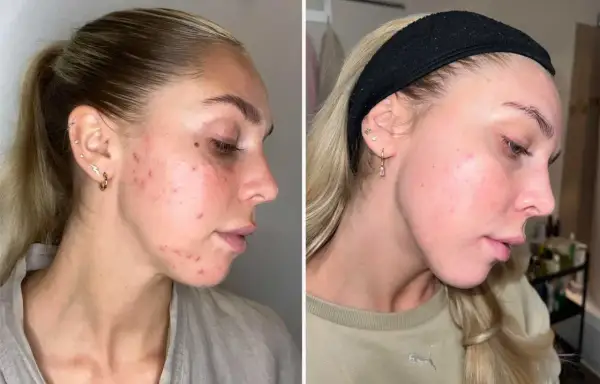 Före- och efterbilder visar en ung kvinna med akne som förbättrats avsevärt. Kanske en del av hennes resa att sluta med p-piller och hitta en hudvårdsrutin som fungerar.