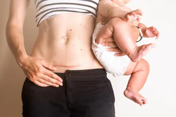En kvinna håller sitt barn. Hon har ett ärr på magen efter ett kejsarsnitt, ett tecken på att hon valt kejsarsnitt eller fått ett avslag på vaginal förlossning.