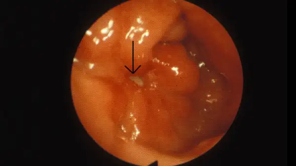 Endoskopisk bild av magsäcken visar rodnad och svullnad, tecken på inflammation magsäcken. En pil pekar mot en liten vit fläck.