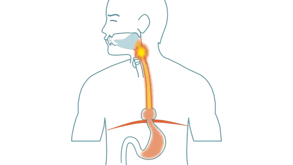 Illustration av matsmältningssystemet med fokus på halsen och magsäcken. Kan visa tolvfingertarmen inflammation symtom.