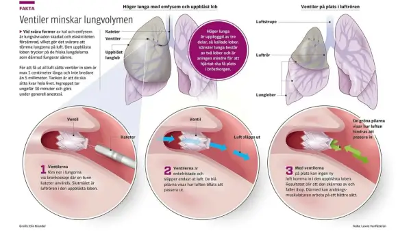 Illustration som visar hur ventiler placeras i lungan för att behandla emfysem. Ventiler förhindrar luft att komma in i en uppblåst lunglob.
