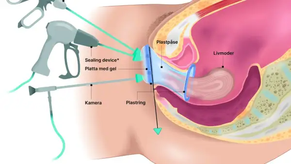 Illustration av en minimalinvasiv endometrios operation med kamera och instrument som arbetar mot livmodern.